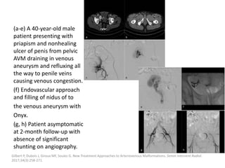 (a-e) A 40-year-old male
patient presenting with
priapism and nonhealing
ulcer of penis from pelvic
AVM draining in venous
aneurysm and refluxing all
the way to penile veins
causing venous congestion.
(f) Endovascular approach
and filling of nidus of to
the venous aneurysm with
Onyx.
(g, h) Patient asymptomatic
at 2-month follow-up with
absence of significant
shunting on angiography.
Gilbert P, Dubois J, Giroux MF, Soulez G. New Treatment Approaches to Arteriovenous Malformations. Semin Intervent Radiol.
2017;34(3):258-271.
 