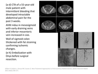 (a-d) CTA of a 55-year-old
male patient with
intermittent bleeding that
developed intractable
abdominal pain for the
past 3 weeks.
AVM nidus in mesosigmoid
with early draining veins
and inferior mesenteric
vein increased in size.
Wall of sigmoid colon
thickened with fat straining
confirming ischemic
changes.
(e-h) Embolization with
Onyx before surgical
resection.
Gilbert P, Dubois J, Giroux MF, Soulez G. New Treatment Approaches to Arteriovenous Malformations. Semin Intervent Radiol.
2017;34(3):258-271.
 