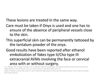 These lesions are treated in the same way.
Care must be taken if Onyx is used and one has to
ensure of the absence of peripheral vessels close
to the skin.
This superficial skin can be permanently tattooed by
the tantalum powder of the onyx.
Good results have been reported after ethanol
embolization of Yakes type II/Cho type III
extracranial AVMs involving the face or cervical
area with or without surgery.
Su L, Wang D, Han Y, Wang Z, Zheng L, Fan X. Absolute ethanol embolization of infiltrating-diffuse extracranial arteriovenous
malformations in the head and neck. Eur J Vasc Endovasc Surg 2015;50(01):114–121
Gilbert P, Dubois J, Giroux MF, Soulez G. New Treatment Approaches to Arteriovenous Malformations. Semin Intervent Radiol.
2017;34(3):258-271.
 