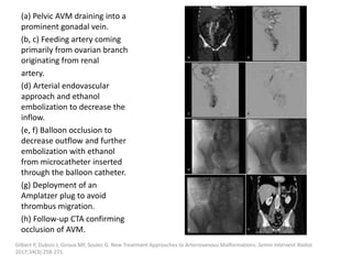 (a) Pelvic AVM draining into a
prominent gonadal vein.
(b, c) Feeding artery coming
primarily from ovarian branch
originating from renal
artery.
(d) Arterial endovascular
approach and ethanol
embolization to decrease the
inflow.
(e, f) Balloon occlusion to
decrease outflow and further
embolization with ethanol
from microcatheter inserted
through the balloon catheter.
(g) Deployment of an
Amplatzer plug to avoid
thrombus migration.
(h) Follow-up CTA confirming
occlusion of AVM.
Gilbert P, Dubois J, Giroux MF, Soulez G. New Treatment Approaches to Arteriovenous Malformations. Semin Intervent Radiol.
2017;34(3):258-271.
 