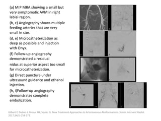 (a) MIP MRA showing a small but
very symptomatic AVM in right
labial region.
(b, c) Angiography shows multiple
feeding arteries that are very
small in size.
(d, e) Microcatheterization as
deep as possible and injection
with Onyx.
(f) Follow-up angiography
demonstrated a residual
nidus at superior aspect too small
for microcatheterization.
(g) Direct puncture under
ultrasound guidance and ethanol
injection.
(h, i)Follow-up angiography
demonstrates complete
embolization.
Gilbert P, Dubois J, Giroux MF, Soulez G. New Treatment Approaches to Arteriovenous Malformations. Semin Intervent Radiol.
2017;34(3):258-271.
 
