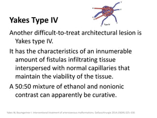 Yakes Type IV
Another difficult-to-treat architectural lesion is
Yakes type IV.
It has the characteristics of an innumerable
amount of fistulas infiltrating tissue
interspersed with normal capillaries that
maintain the viability of the tissue.
A 50:50 mixture of ethanol and nonionic
contrast can apparently be curative.
Yakes W, Baumgartner I. Interventional treatment of arteriovenous malformations. Gefasschirurgie 2014;19(04):325–330
 