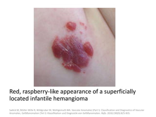 Red, raspberry-like appearance of a superficially
located infantile hemangioma
Sadick M, Müller-Wille R, Wildgruber M, Wohlgemuth WA. Vascular Anomalies (Part I): Classification and Diagnostics of Vascular
Anomalies. Gefäßanomalien (Teil I): Klassifikation und Diagnostik von Gefäßanomalien. Rofo. 2018;190(9):825-835.
 
