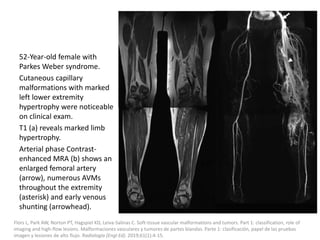 52-Year-old female with
Parkes Weber syndrome.
Cutaneous capillary
malformations with marked
left lower extremity
hypertrophy were noticeable
on clinical exam.
T1 (a) reveals marked limb
hypertrophy.
Arterial phase Contrast-
enhanced MRA (b) shows an
enlarged femoral artery
(arrow), numerous AVMs
throughout the extremity
(asterisk) and early venous
shunting (arrowhead).
Flors L, Park AW, Norton PT, Hagspiel KD, Leiva-Salinas C. Soft-tissue vascular malformations and tumors. Part 1: classification, role of
imaging and high-flow lesions. Malformaciones vasculares y tumores de partes blandas. Parte 1: clasificación, papel de las pruebas
imagen y lesiones de alto flujo. Radiologia (Engl Ed). 2019;61(1):4-15.
 