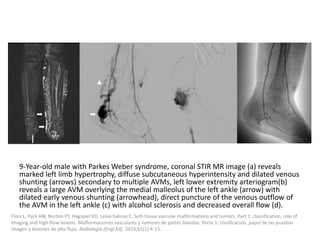 9-Year-old male with Parkes Weber syndrome, coronal STIR MR image (a) reveals
marked left limb hypertrophy, diffuse subcutaneous hyperintensity and dilated venous
shunting (arrows) secondary to multiple AVMs, left lower extremity arteriogram(b)
reveals a large AVM overlying the medial malleolus of the left ankle (arrow) with
dilated early venous shunting (arrowhead), direct puncture of the venous outflow of
the AVM in the left ankle (c) with alcohol sclerosis and decreased overall flow (d).
Flors L, Park AW, Norton PT, Hagspiel KD, Leiva-Salinas C. Soft-tissue vascular malformations and tumors. Part 1: classification, role of
imaging and high-flow lesions. Malformaciones vasculares y tumores de partes blandas. Parte 1: clasificación, papel de las pruebas
imagen y lesiones de alto flujo. Radiologia (Engl Ed). 2019;61(1):4-15.
 
