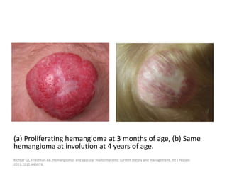(a) Proliferating hemangioma at 3 months of age, (b) Same
hemangioma at involution at 4 years of age.
Richter GT, Friedman AB. Hemangiomas and vascular malformations: current theory and management. Int J Pediatr.
2012;2012:645678.
 