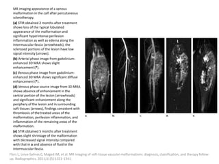 MR imaging appearance of a venous
malformation in the calf after percutaneous
sclerotherapy.
(a) STIR obtained 2 months after treatment
shows loss of the typical lobulated
appearance of the malformation and
significant hyperintense perilesion
inflammation as well as edema along the
intermuscular fascia (arrowheads), the
sclerosed portions of the lesion have low
signal intensity (arrows).
(b) Arterial phase image from gadolinium-
enhanced 3D MRA shows slight
enhancement (*).
(c) Venous phase image from gadolinium-
enhanced 3D MRA shows significant diffuse
enhancement (*).
(d) Venous phase source image from 3D MRA
shows absence of enhancement in the
central portion of the lesion (arrowheads)
and significant enhancement along the
periphery of the lesion and in surrounding
soft tissues (arrows), findings consistent with
thrombosis of the treated areas of the
malformation, perilesion inflammation, and
inflammation of the remaining areas of the
malformation.
(e) STIR obtained 5 months after treatment
shows slight shrinkage of the malformation
with decreased signal intensity compared
with that in a and absence of fluid in the
intermuscular fascia.
Flors L, Leiva-Salinas C, Maged IM, et al. MR imaging of soft-tissue vascular malformations: diagnosis, classification, and therapy follow-
up. Radiographics. 2011;31(5):1321-1341.
 