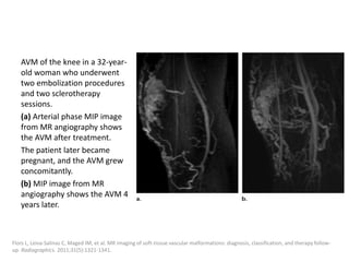 AVM of the knee in a 32-year-
old woman who underwent
two embolization procedures
and two sclerotherapy
sessions.
(a) Arterial phase MIP image
from MR angiography shows
the AVM after treatment.
The patient later became
pregnant, and the AVM grew
concomitantly.
(b) MIP image from MR
angiography shows the AVM 4
years later.
Flors L, Leiva-Salinas C, Maged IM, et al. MR imaging of soft-tissue vascular malformations: diagnosis, classification, and therapy follow-
up. Radiographics. 2011;31(5):1321-1341.
 