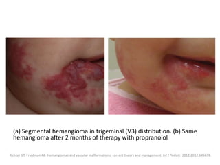 (a) Segmental hemangioma in trigeminal (V3) distribution. (b) Same
hemangioma after 2 months of therapy with propranolol
Richter GT, Friedman AB. Hemangiomas and vascular malformations: current theory and management. Int J Pediatr. 2012;2012:645678.
 