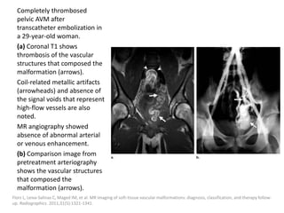 Completely thrombosed
pelvic AVM after
transcatheter embolization in
a 29-year-old woman.
(a) Coronal T1 shows
thrombosis of the vascular
structures that composed the
malformation (arrows).
Coil-related metallic artifacts
(arrowheads) and absence of
the signal voids that represent
high-flow vessels are also
noted.
MR angiography showed
absence of abnormal arterial
or venous enhancement.
(b) Comparison image from
pretreatment arteriography
shows the vascular structures
that composed the
malformation (arrows).
Flors L, Leiva-Salinas C, Maged IM, et al. MR imaging of soft-tissue vascular malformations: diagnosis, classification, and therapy follow-
up. Radiographics. 2011;31(5):1321-1341.
 