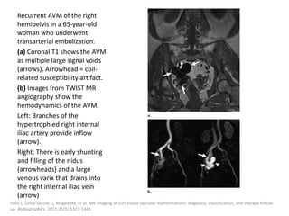 Recurrent AVM of the right
hemipelvis in a 65-year-old
woman who underwent
transarterial embolization.
(a) Coronal T1 shows the AVM
as multiple large signal voids
(arrows). Arrowhead = coil-
related susceptibility artifact.
(b) Images from TWIST MR
angiography show the
hemodynamics of the AVM.
Left: Branches of the
hypertrophied right internal
iliac artery provide inflow
(arrow).
Right: There is early shunting
and filling of the nidus
(arrowheads) and a large
venous varix that drains into
the right internal iliac vein
(arrow)
Flors L, Leiva-Salinas C, Maged IM, et al. MR imaging of soft-tissue vascular malformations: diagnosis, classification, and therapy follow-
up. Radiographics. 2011;31(5):1321-1341.
 
