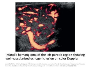 Infantile hemangioma of the left parotid region showing
well-vascularized echogenic lesion on color Doppler
Sadick M, Müller-Wille R, Wildgruber M, Wohlgemuth WA. Vascular Anomalies (Part I): Classification and Diagnostics of Vascular
Anomalies. Gefäßanomalien (Teil I): Klassifikation und Diagnostik von Gefäßanomalien. Rofo. 2018;190(9):825-835.
 