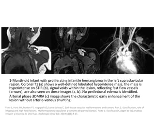 1-Month-old infant with proliferating infantile hemangioma in the left supraclavicular
region. Coronal T1 (a) shows a well-defined lobulated hypointense mass, the mass is
hyperintense on STIR (b), signal voids within the lesion, reflecting fast flow vessels
(arrows), are also seen on these images (a, b). No perilesional edema is identified.
Arterial phase 3DMRA (c) image shows the characteristic early enhancement of the
lesion without arterio-venous shunting.
Flors L, Park AW, Norton PT, Hagspiel KD, Leiva-Salinas C. Soft-tissue vascular malformations and tumors. Part 1: classification, role of
imaging and high-flow lesions. Malformaciones vasculares y tumores de partes blandas. Parte 1: clasificación, papel de las pruebas
imagen y lesiones de alto flujo. Radiologia (Engl Ed). 2019;61(1):4-15.
 
