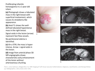 Proliferating infantile
hemangioma in a 1-year-old
infant.
(a) Photograph shows a lobulated
mass in the right breast with
superficial involvement, which
causes its strawberry-like
appearance.
(b) Axial T1 shows the well-
defined lobulated hypointense
mass in the right breast.
Signal voids in the lesion (arrow)
represent fast-flow vessels.
No perilesional edema is
identified.
(c) On a STIR, the mass is hyper-
intense. Arrow = signal voids in
the lesion.
(d) Image from arterial phase 3D
MR angiography shows
characteristic early enhancement
of the lesion without
arteriovenous shunting.
Flors L, Leiva-Salinas C, Maged IM, et al. MR imaging of soft-tissue vascular malformations: diagnosis, classification, and therapy follow-
up. Radiographics. 2011;31(5):1321-1341.
 