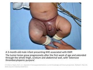 A 3-month-old male infant presenting KHE associated with KMP.
The tumor lesion grew progressively after the first week of age and extended
through the whole thigh, scrotum and abdominal wall, with ‘extensive
thrombocytopenic purpura’.
Ji Y, Chen S, Yang K, Xia C, Li L. Kaposiform hemangioendothelioma: current knowledge and future perspectives. Orphanet J Rare Dis.
2020;15(1):39. Published 2020 Feb 3.
 