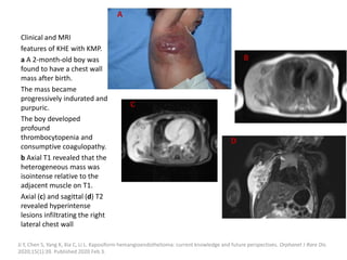 Clinical and MRI
features of KHE with KMP.
a A 2-month-old boy was
found to have a chest wall
mass after birth.
The mass became
progressively indurated and
purpuric.
The boy developed
profound
thrombocytopenia and
consumptive coagulopathy.
b Axial T1 revealed that the
heterogeneous mass was
isointense relative to the
adjacent muscle on T1.
Axial (c) and sagittal (d) T2
revealed hyperintense
lesions infiltrating the right
lateral chest wall
Ji Y, Chen S, Yang K, Xia C, Li L. Kaposiform hemangioendothelioma: current knowledge and future perspectives. Orphanet J Rare Dis.
2020;15(1):39. Published 2020 Feb 3.
A
B
C
D
 