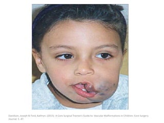 Davidson, Joseph & Ford, Kathryn. (2015). A Core Surgical Trainee's Guide to: Vascular Malformations in Children. Core Surgery
Journal. 5. 47.
 