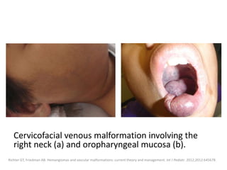 Cervicofacial venous malformation involving the
right neck (a) and oropharyngeal mucosa (b).
Richter GT, Friedman AB. Hemangiomas and vascular malformations: current theory and management. Int J Pediatr. 2012;2012:645678.
 