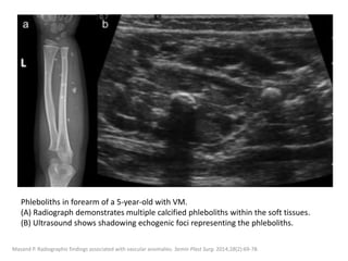 Phleboliths in forearm of a 5-year-old with VM.
(A) Radiograph demonstrates multiple calcified phleboliths within the soft tissues.
(B) Ultrasound shows shadowing echogenic foci representing the phleboliths.
Masand P. Radiographic findings associated with vascular anomalies. Semin Plast Surg. 2014;28(2):69-78.
 