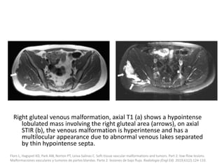 Right gluteal venous malformation, axial T1 (a) shows a hypointense
lobulated mass involving the right gluteal area (arrows), on axial
STIR (b), the venous malformation is hyperintense and has a
multilocular appearance due to abnormal venous lakes separated
by thin hypointense septa.
Flors L, Hagspiel KD, Park AW, Norton PT, Leiva-Salinas C. Soft-tissue vascular malformations and tumors. Part 2: low-flow lesions.
Malformaciones vasculares y tumores de partes blandas. Parte 2: lesiones de bajo flujo. Radiologia (Engl Ed). 2019;61(2):124-133.
 