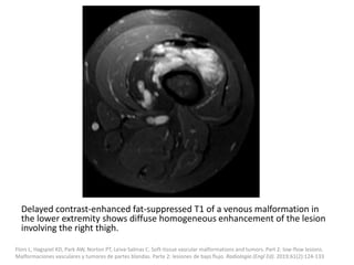 Delayed contrast-enhanced fat-suppressed T1 of a venous malformation in
the lower extremity shows diffuse homogeneous enhancement of the lesion
involving the right thigh.
Flors L, Hagspiel KD, Park AW, Norton PT, Leiva-Salinas C. Soft-tissue vascular malformations and tumors. Part 2: low-flow lesions.
Malformaciones vasculares y tumores de partes blandas. Parte 2: lesiones de bajo flujo. Radiologia (Engl Ed). 2019;61(2):124-133
 