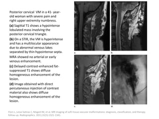 Posterior cervical VM in a 41- year-
old woman with severe pain and
right upper extremity numbness.
(a) Sagittal T1 shows a hypointense
lobulated mass involving the
posterior cervical triangle.
(b) On a STIR, the VM is hyperintense
and has a multilocular appearance
due to abnormal venous lakes
separated by thin hypointense septa.
MRA showed no arterial or early
venous enhancement.
(c) Delayed contrast-enhanced fat-
suppressed T1 shows diffuse
homogeneous enhancement of the
lesion.
(d) Image obtained with direct
percutaneous injection of contrast
material also shows diffuse
homogeneous enhancement of the
lesion.
Flors L, Leiva-Salinas C, Maged IM, et al. MR imaging of soft-tissue vascular malformations: diagnosis, classification, and therapy
follow-up. Radiographics. 2011;31(5):1321-1341.
 