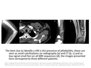 The best clue to identify a VM is the presence of phleboliths, these are
seen as small calcifications on radiography (a) and CT (b, c) and as
low signal small foci on all MRI sequences (d), the images presented
here correspond to three different patients.
Flors L, Hagspiel KD, Park AW, Norton PT, Leiva-Salinas C. Soft-tissue vascular malformations and tumors. Part 2: low-flow lesions.
Malformaciones vasculares y tumores de partes blandas. Parte 2: lesiones de bajo flujo. Radiologia (Engl Ed). 2019;61(2):124-133.
 