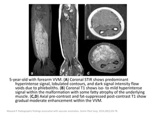 5-year-old with forearm VVM. (A) Coronal STIR shows predominant
hyperintense signal, lobulated contours, and dark signal intensity flow
voids due to phleboliths. (B) Coronal T1 shows iso- to mild hyperintense
signal within the malformation with some fatty atrophy of the underlying
muscle. (C,D) Axial pre-contrast and fat-suppressed post-contrast T1 show
gradual moderate enhancement within the VVM.
Masand P. Radiographic findings associated with vascular anomalies. Semin Plast Surg. 2014;28(2):69-78.
 