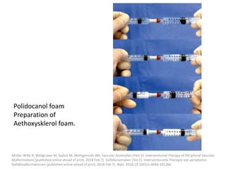Polidocanol foam
Preparation of
Aethoxysklerol foam.
Müller-Wille R, Wildgruber M, Sadick M, Wohlgemuth WA. Vascular Anomalies (Part II): Interventional Therapy of Peripheral Vascular
Malformations [published online ahead of print, 2018 Feb 7]. Gefäßanomalien (Teil II): Interventionelle Therapie von peripheren
Gefäßmalformationen [published online ahead of print, 2018 Feb 7]. Rofo. 2018;10.1055/s-0044-101266
 