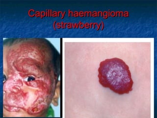 Capillary haemangiomaCapillary haemangioma
(strawberry)(strawberry)
 