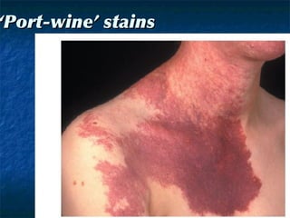 ‘‘Port-wine’ stainsPort-wine’ stains
 