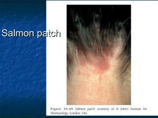 Salmon patchSalmon patch
 