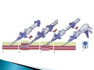 vascular closure devices II.pptx