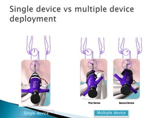 vascular closure devices II.pptx