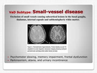 VaD Subtype:
 Psychomotor slowing, memory impairment, frontal dysfunction
 Parkinsonism, ataxia, and urinary incontinence
Occlusion of small vessels causing subcortical lesions in the basal ganglia,
thalamus, internal capsule and subhemispheric white matter.
 