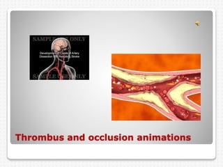 Thrombus and occlusion animations
 