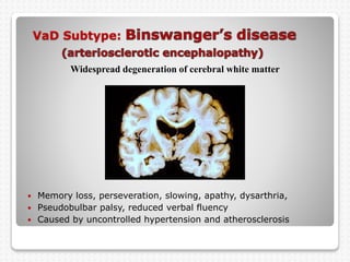 VaD Subtype:
 Memory loss, perseveration, slowing, apathy, dysarthria,
 Pseudobulbar palsy, reduced verbal fluency
 Caused by uncontrolled hypertension and atherosclerosis
Widespread degeneration of cerebral white matter
 