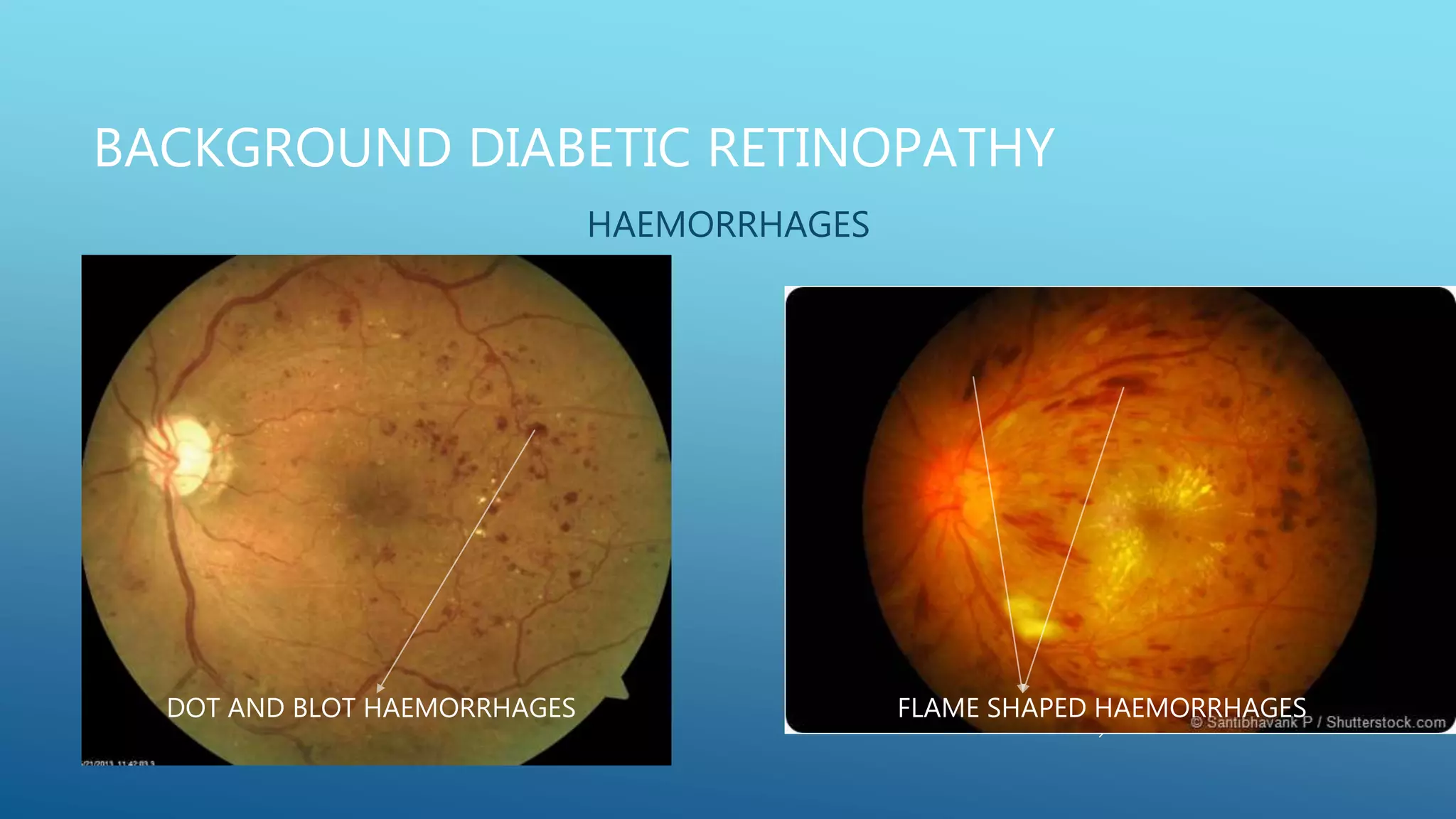 HAEMORRHAGES
BACKGROUND DIABETIC RETINOPATHY
FLAME SHAPED HAEMORRHAGES
DOT AND BLOT HAEMORRHAGES
 