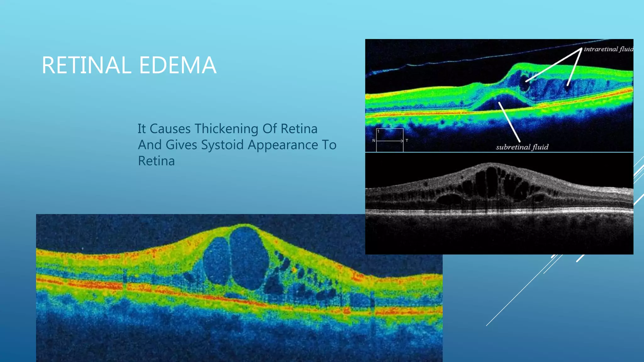 RETINAL EDEMA
It Causes Thickening Of Retina
And Gives Systoid Appearance To
Retina
 