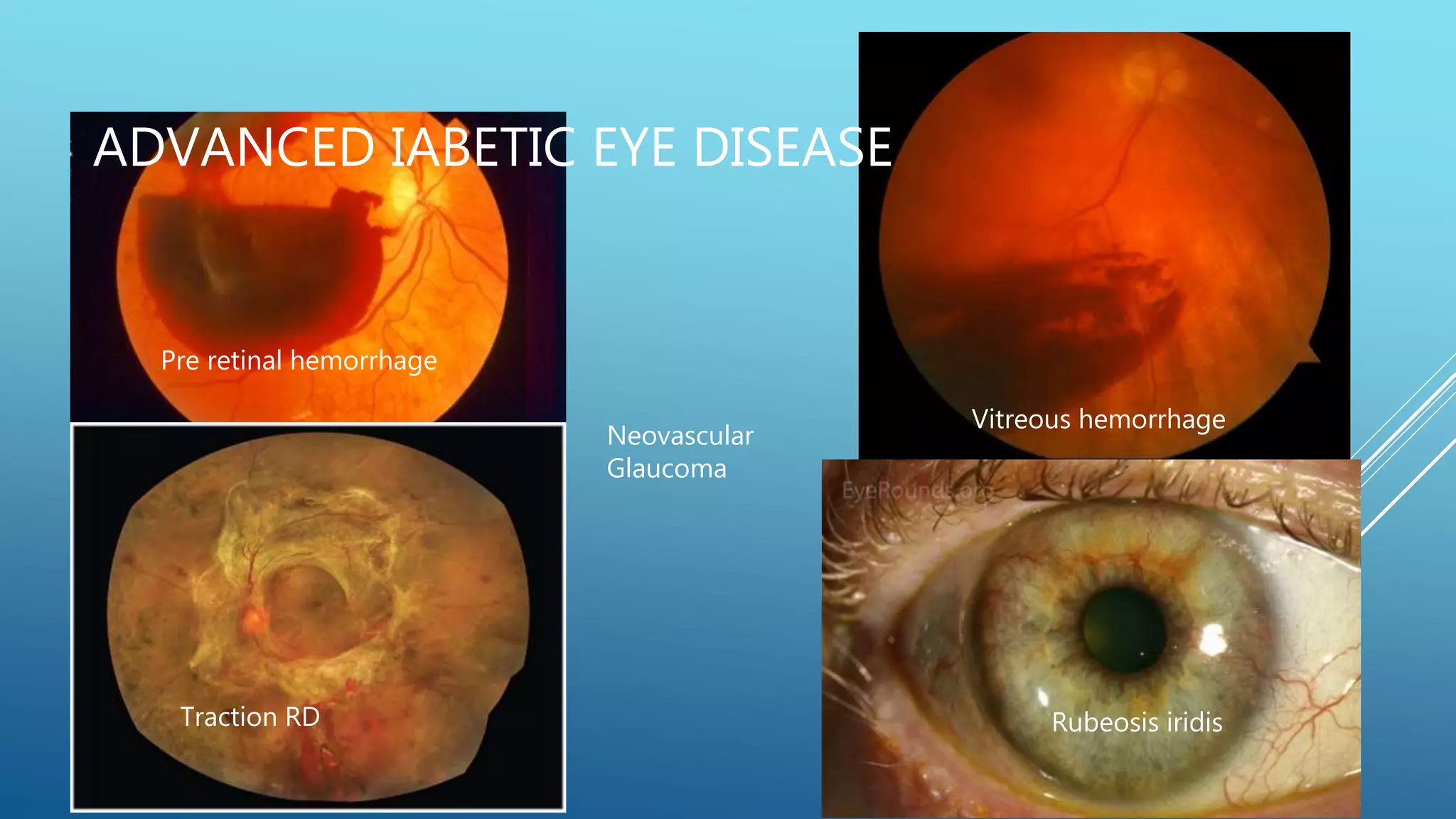 ADVANCED IABETIC EYE DISEASE
Pre retinal hemorrhage
Vitreous hemorrhage
Traction RD Rubeosis iridis
Neovascular
Glaucoma
 