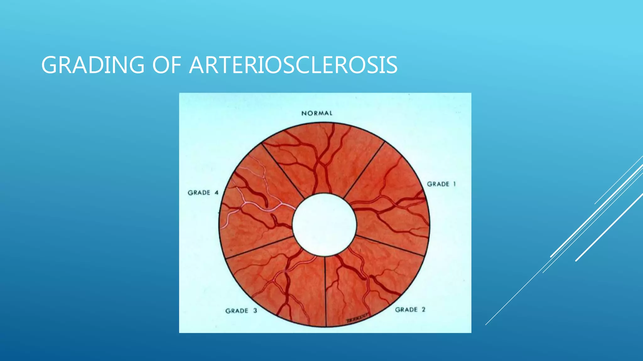 GRADING OF ARTERIOSCLEROSIS
 