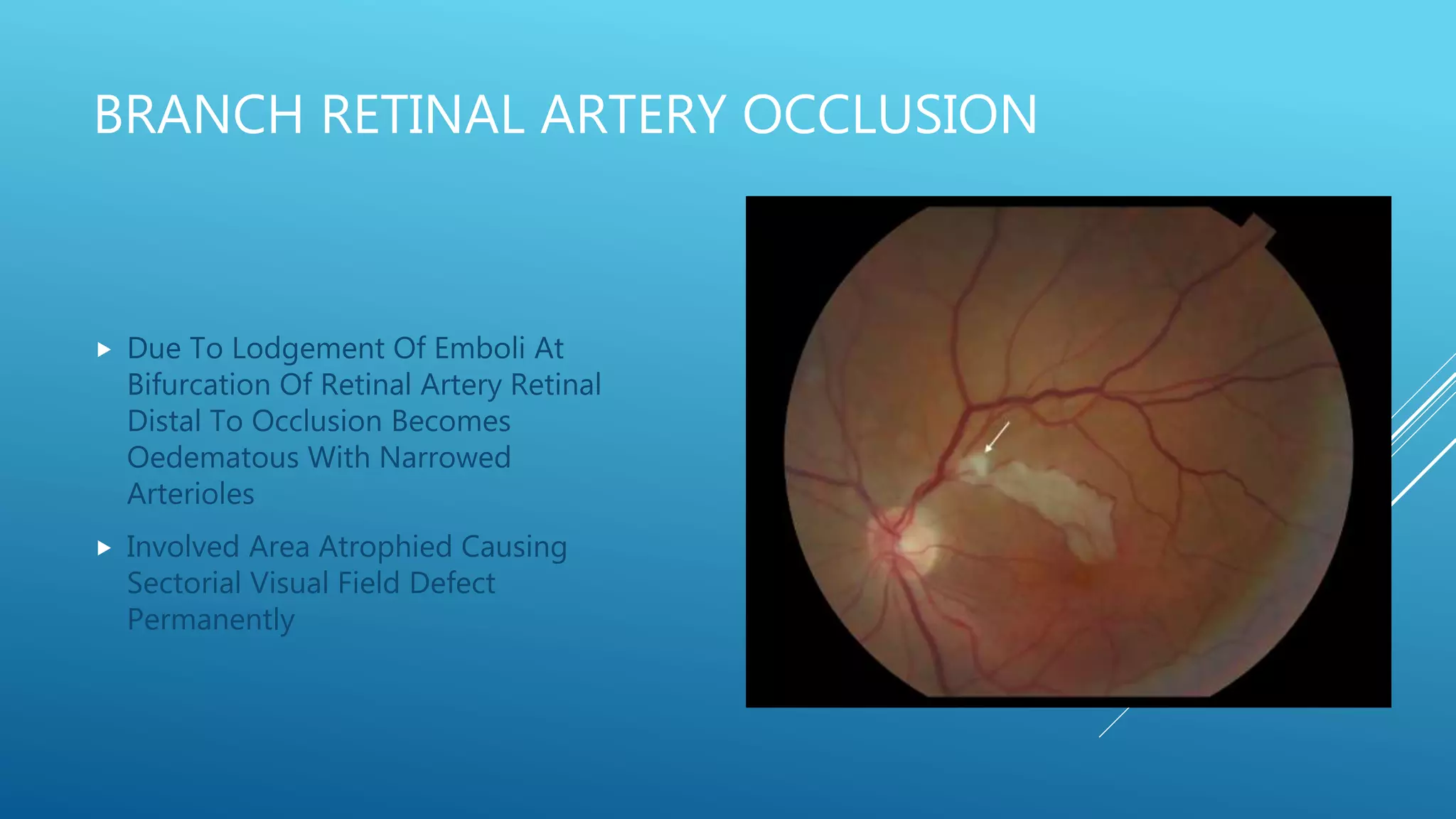 BRANCH RETINAL ARTERY OCCLUSION
 Due To Lodgement Of Emboli At
Bifurcation Of Retinal Artery Retinal
Distal To Occlusion Becomes
Oedematous With Narrowed
Arterioles
 Involved Area Atrophied Causing
Sectorial Visual Field Defect
Permanently
 
