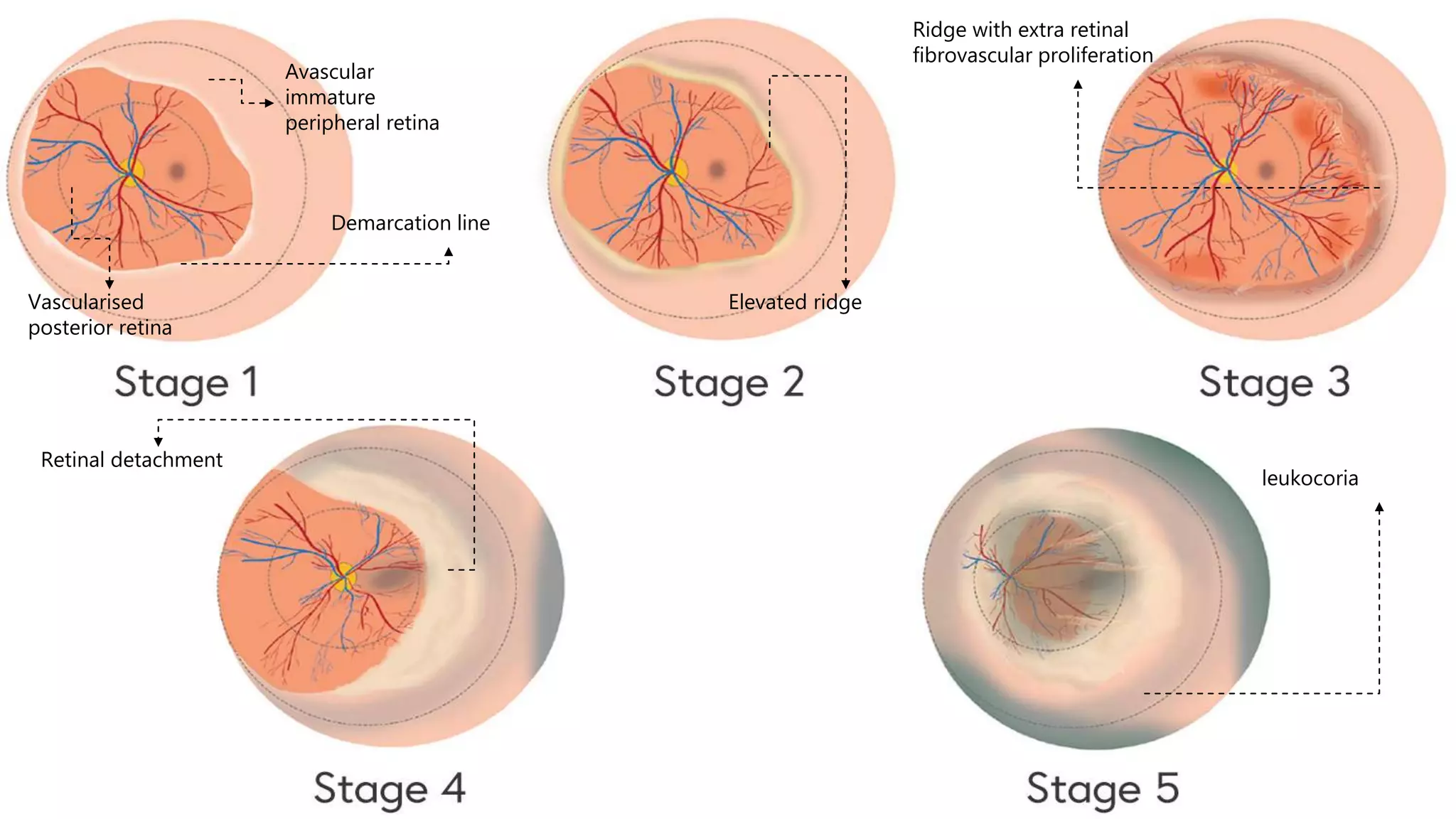 
Vascularised
posterior retina
Avascular
immature
peripheral retina
Demarcation line
Elevated ridge
Ridge with extra retinal
fibrovascular proliferation
Retinal detachment
leukocoria
 