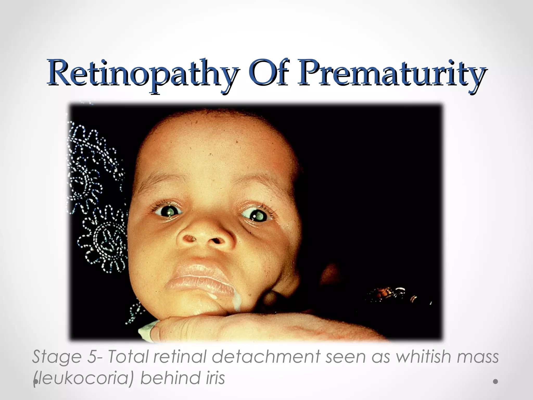 Retinopathy Of PrematurityRetinopathy Of Prematurity
Stage 5- Total retinal detachment seen as whitish mass
(leukocoria) behind iris
 