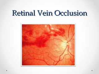 Some Vascular disorders of retina | PPT