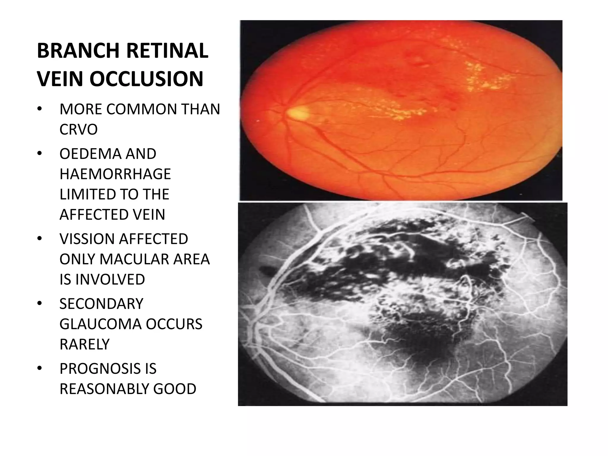 Vascular disorders of retina | PPTX