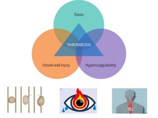 Vascular Events in Ophthalmology | PPTX