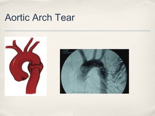 Aortic Arch Tear 
 