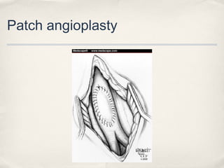 Patch angioplasty 
 