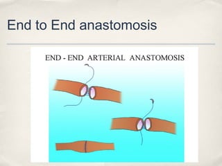 End to End anastomosis 
 